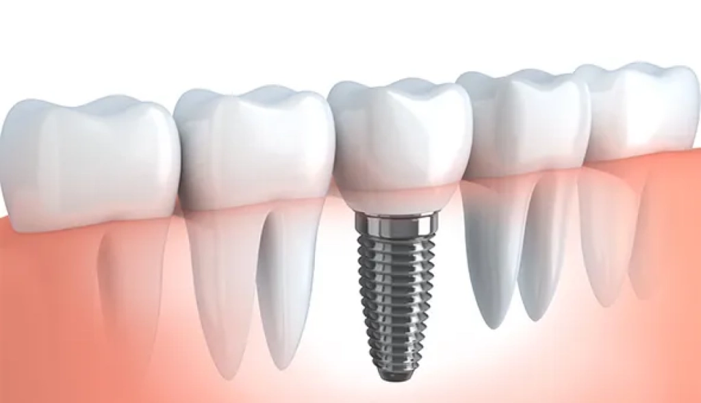 Implante Dentário