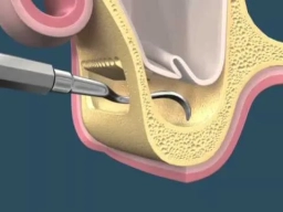 Implante Dentário