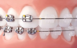 Implante Dentário